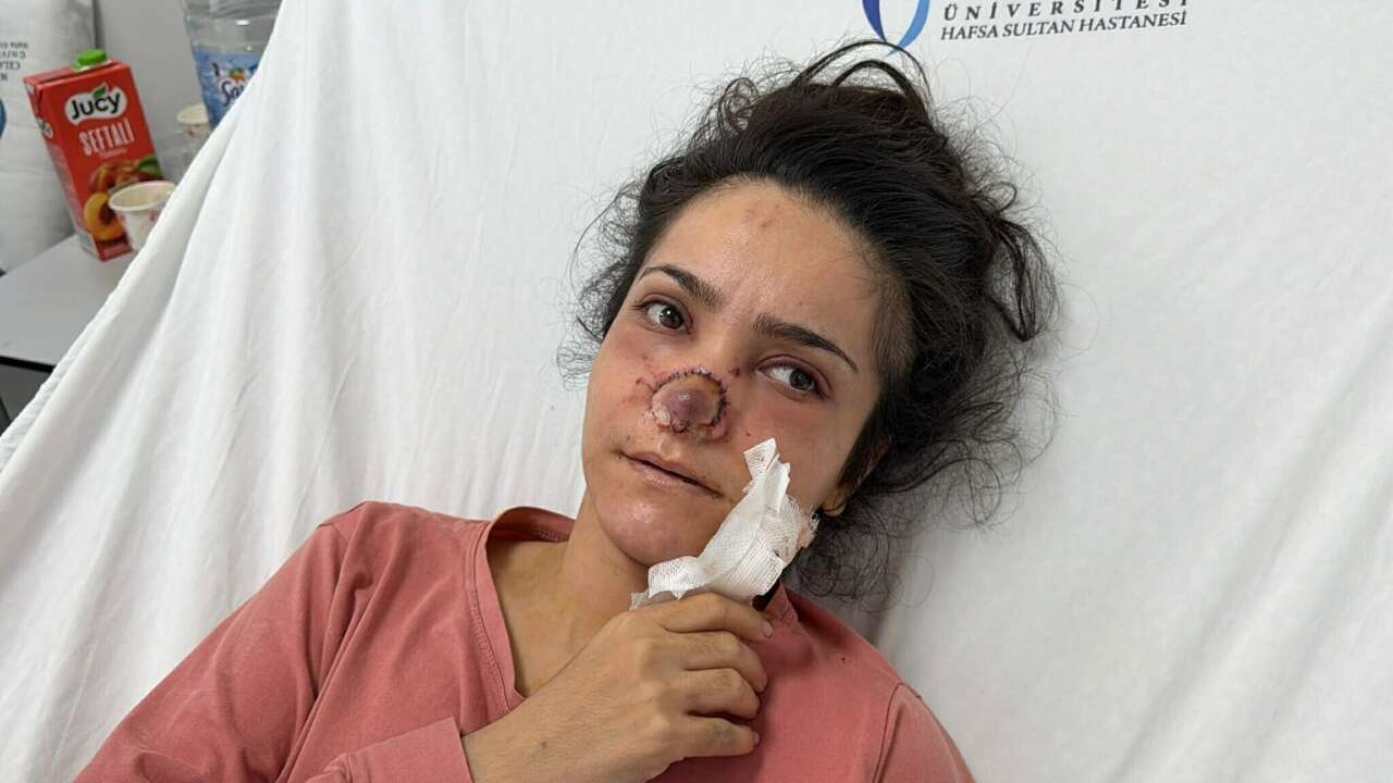 Eşi burnunu ısırıp koparmıştı! Genç kadın o gece yaşananları anlattı 6
