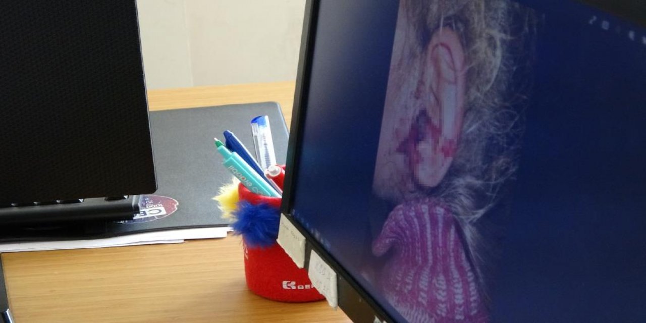 3 yaşındaki kızın kulağından onlarca canlı kurtçuk çıktı