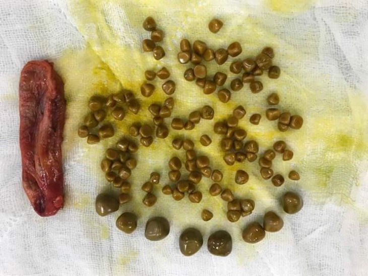 Karın ağrısıyla hastaneye gitti, safra kesesinden 120’ye yakın taş çıktı