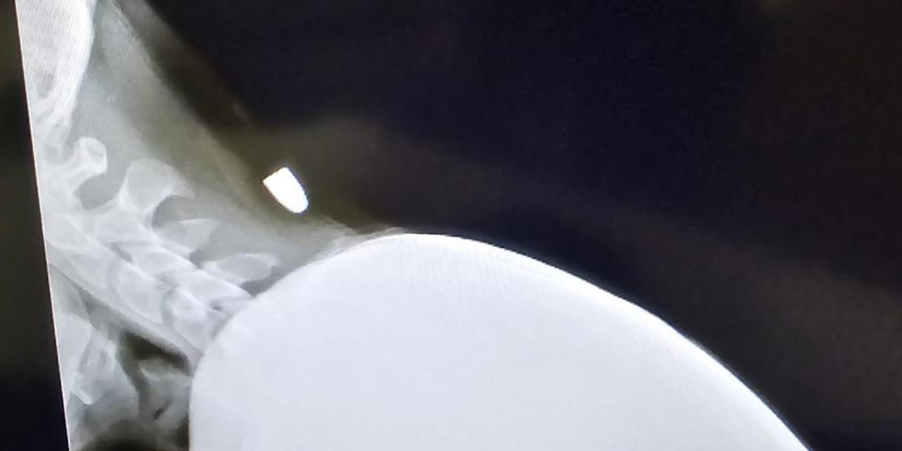 Yorgun mermi isabet eden genç 2 santimle ölümden kurtuldu