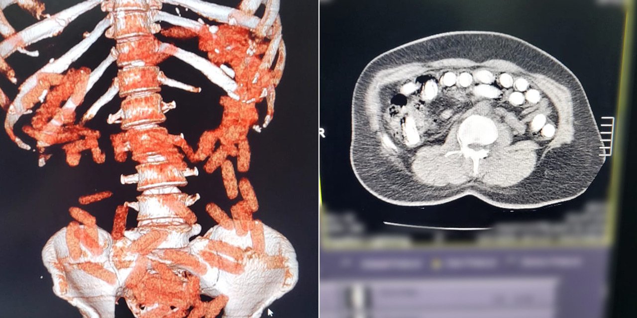 Röntgende ortaya çıktı, polislerde şaşırdı