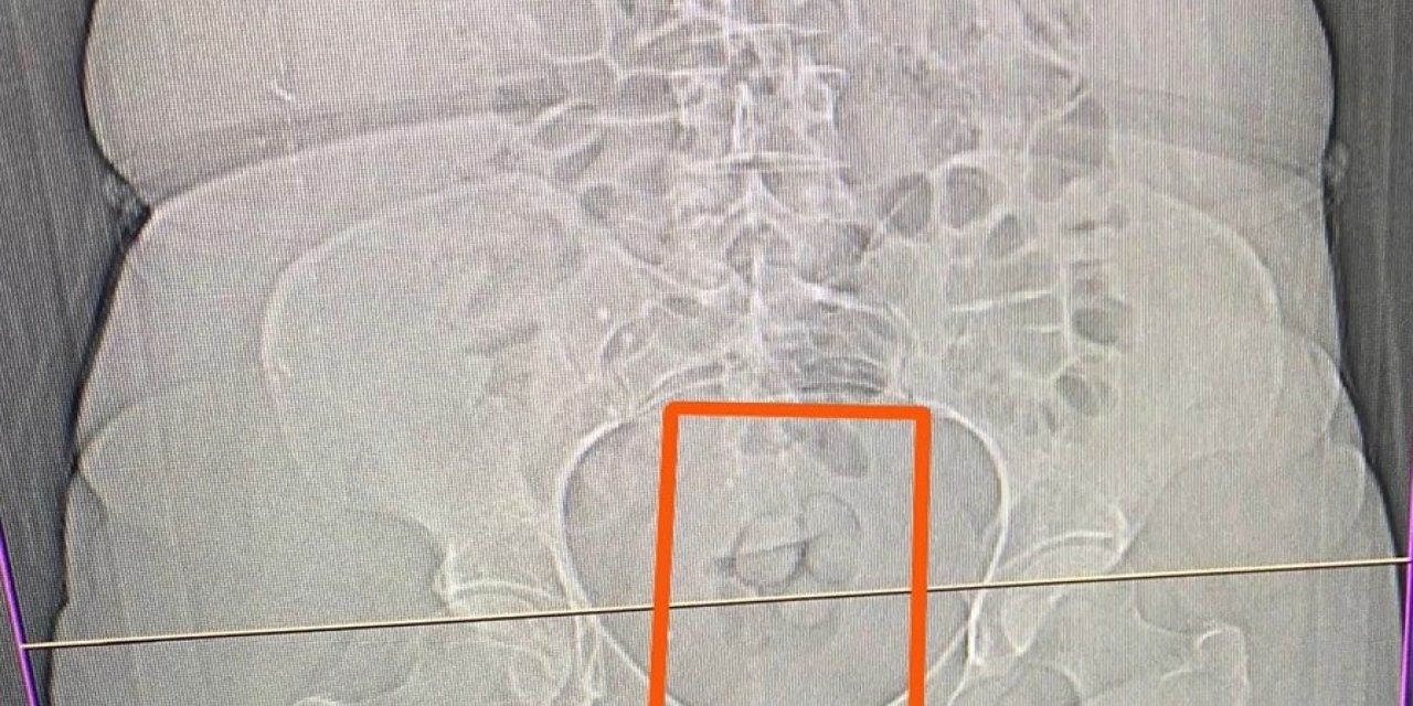 Çekilen tomografi yakayı ele verdi! Polisleri atlatamadı