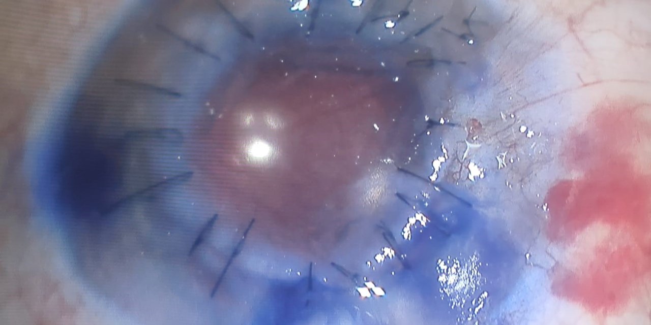 Konya'daki göz bankası 25 yıllık karanlığa son verdi