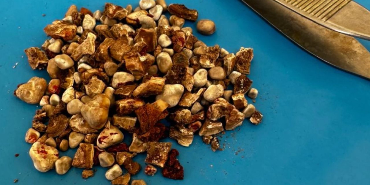 Böbreklerinden 300'ün üzerinde taş çıktı! 'Hatırası var' deyip eve götürdü