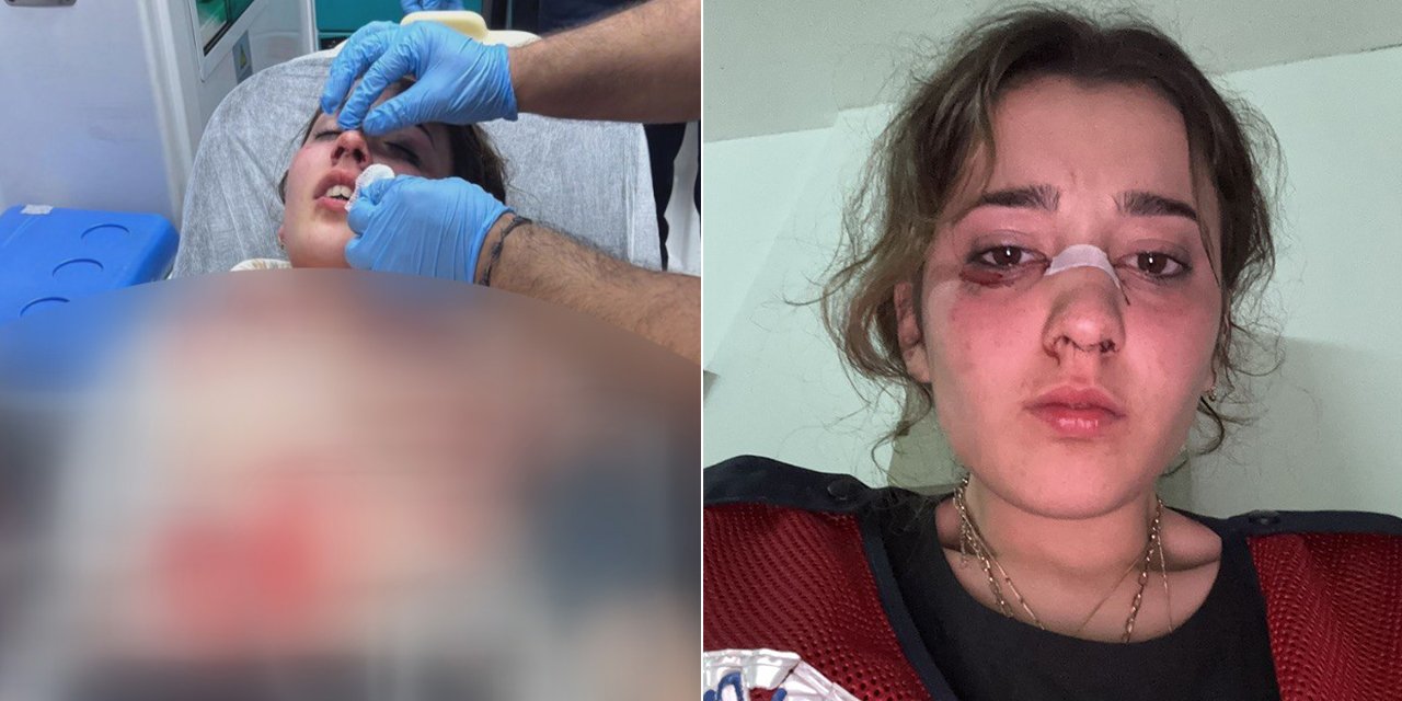 Bayram tatili kabusa döndü! Genç kadın nişanlısı tarafından darbedildi