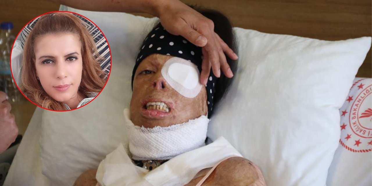 Eski sevgilinin kezzapla hayatını kararttığı kadın 4 yıldır yaşam savaşı veriyor