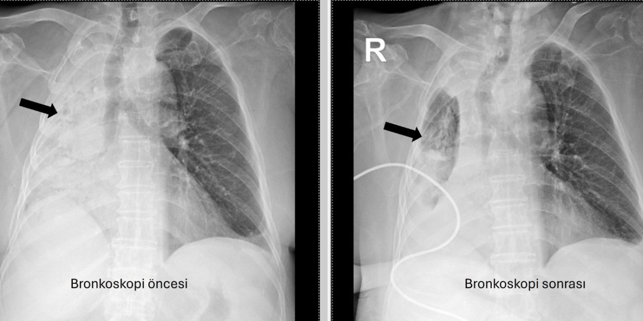 5 ay önce yediği pizza akciğerini tamamen kapattı