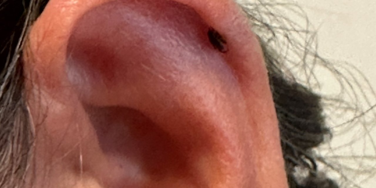 Hayatının şokunu yaşadı! Kulağının içinden kene çıktı