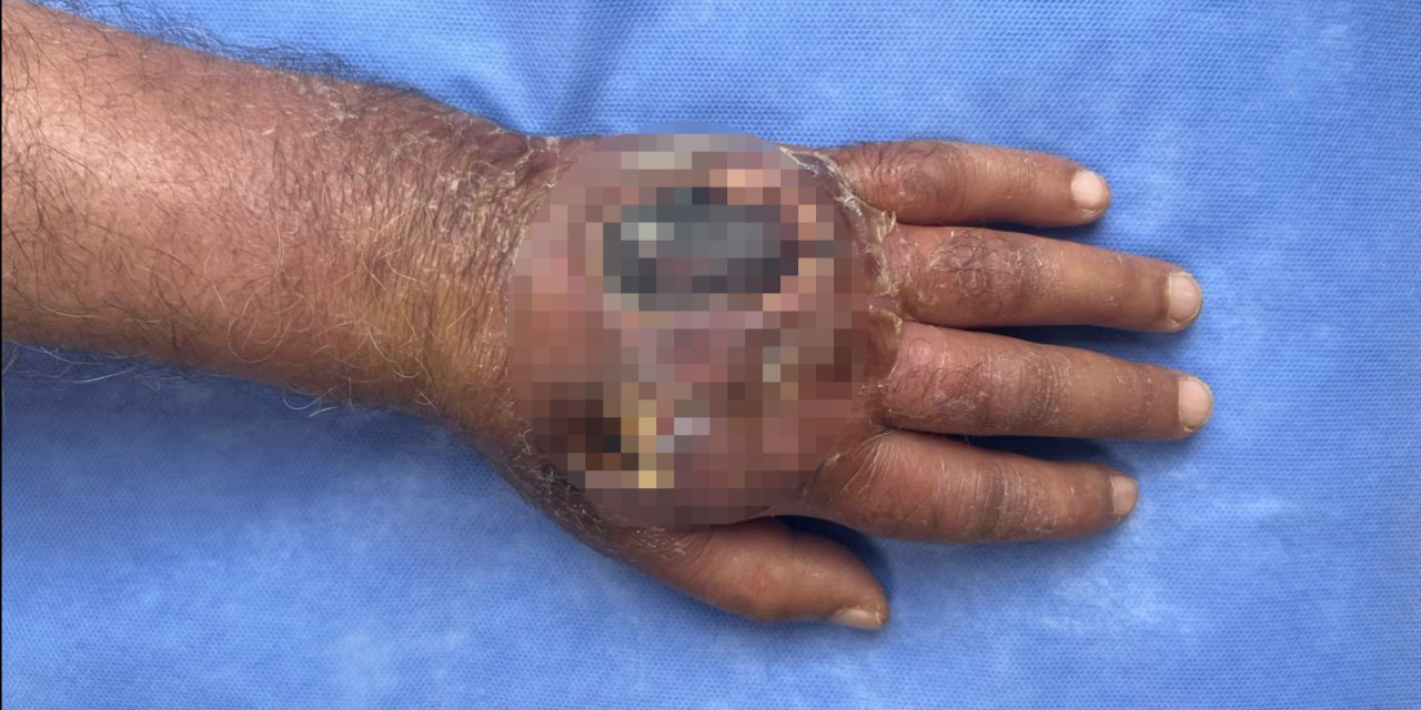 Böylesi ilk defa görüldü! Hırsızın ısırığı esnafı kolundan ediyordu