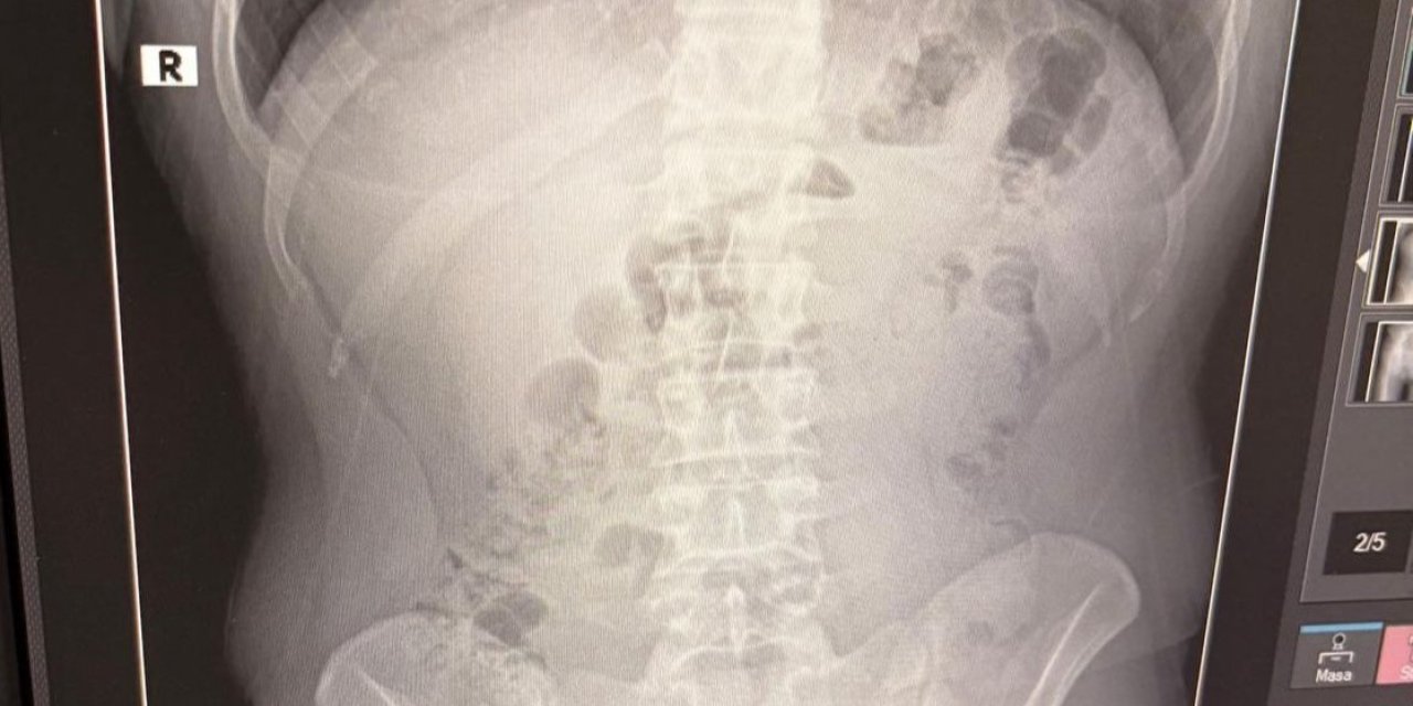 Midelerinden uyuşturucu çıkan yabancı uyruklu 3 kişi tutuklandı