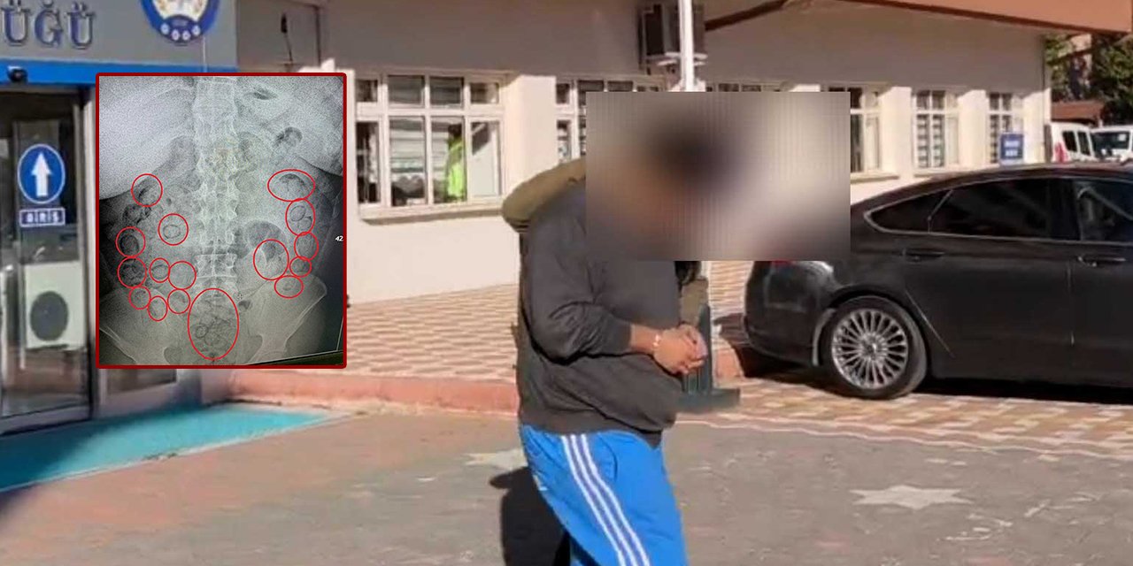 Midesinden çıkanlar şaşkına çevirdi! 101 parça halinde yutmuş