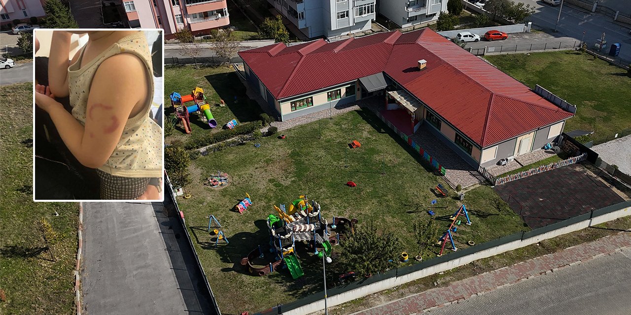 Kreşte şok iddia! Öğretmen, 3 yaşındaki çocuğun kolunu ısırdı