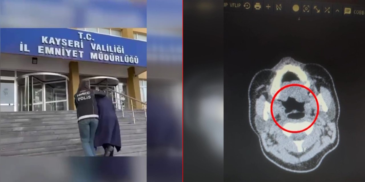 Midesinden 500 gram uyuşturucu çıktı