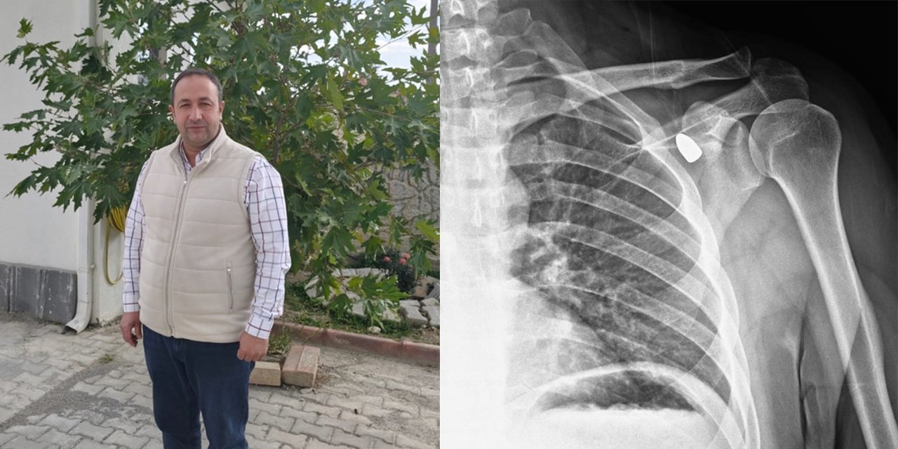 Konya’da 6 yıl omzunda taşıdığı mermi mucizeyle çıktı