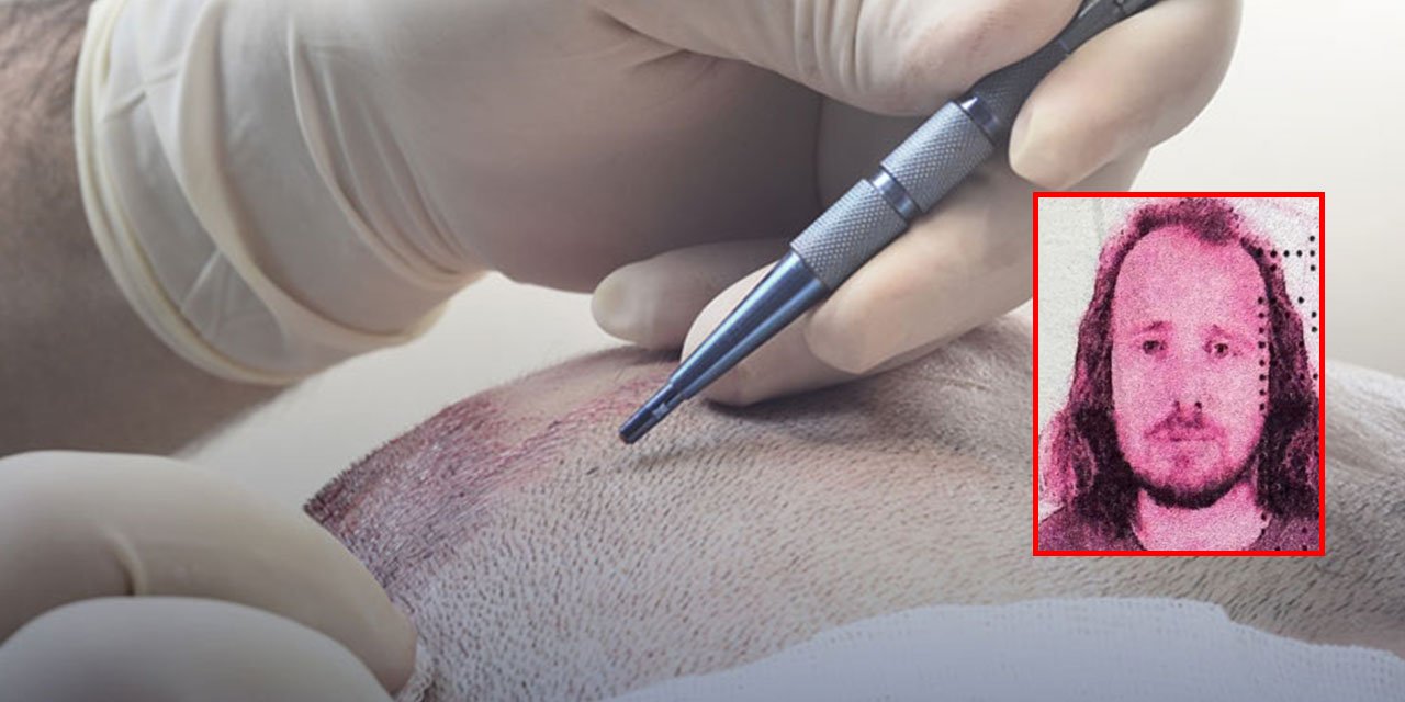 Saç ekiminden sonra hayatını kaybetti