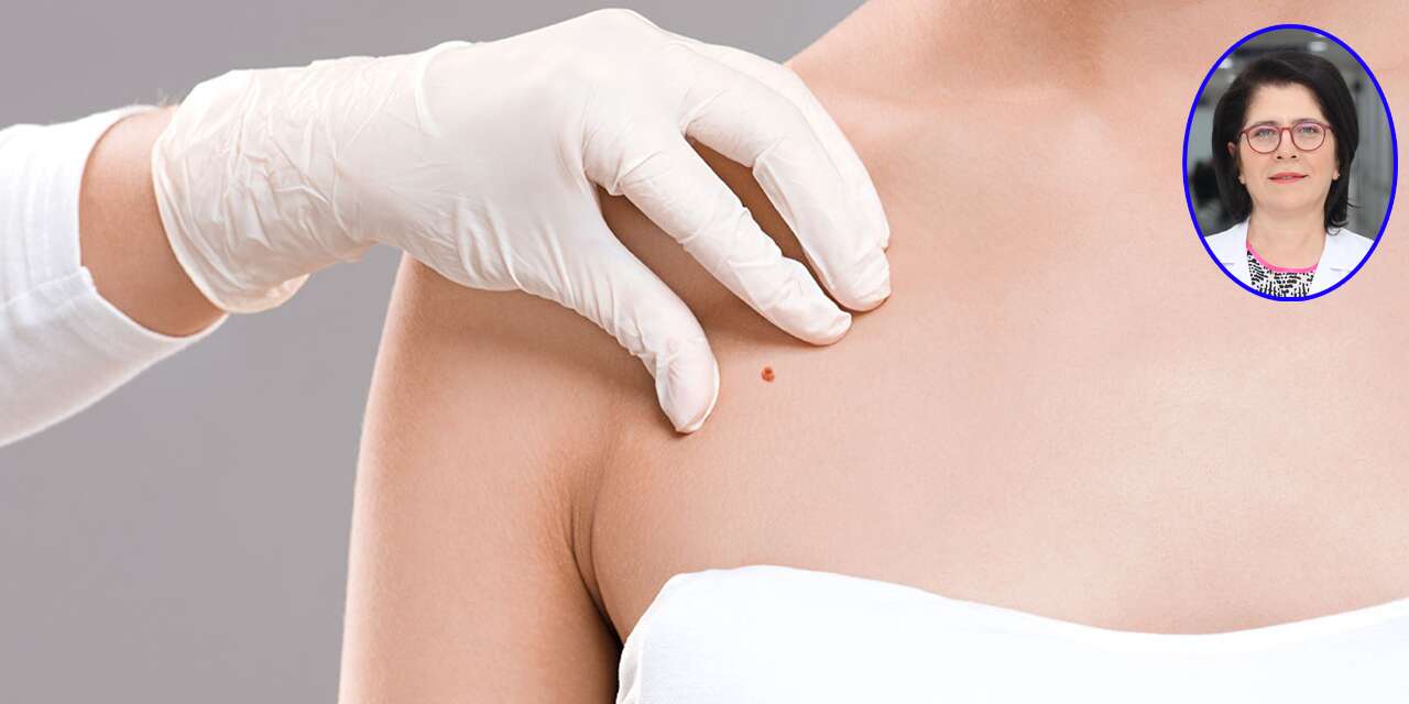 Konya'da uzman isim uyardı! Ciltte çıkan kırmızı benleri hafife almayın