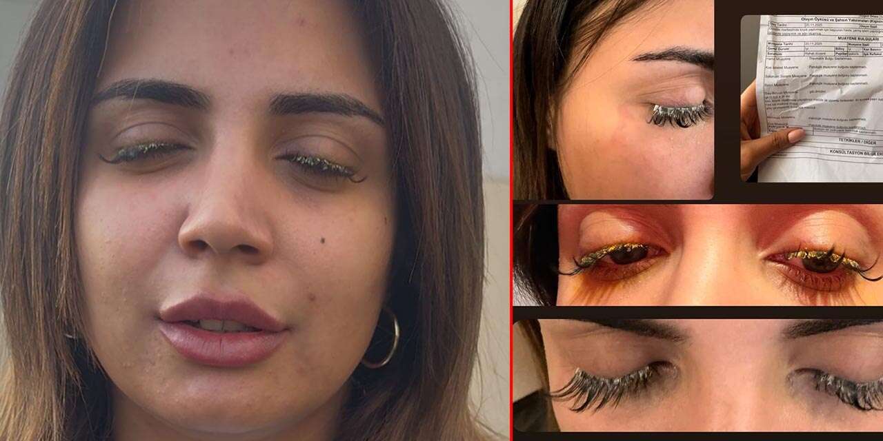 Güzellik için gitti, görme yetisini kaybetti