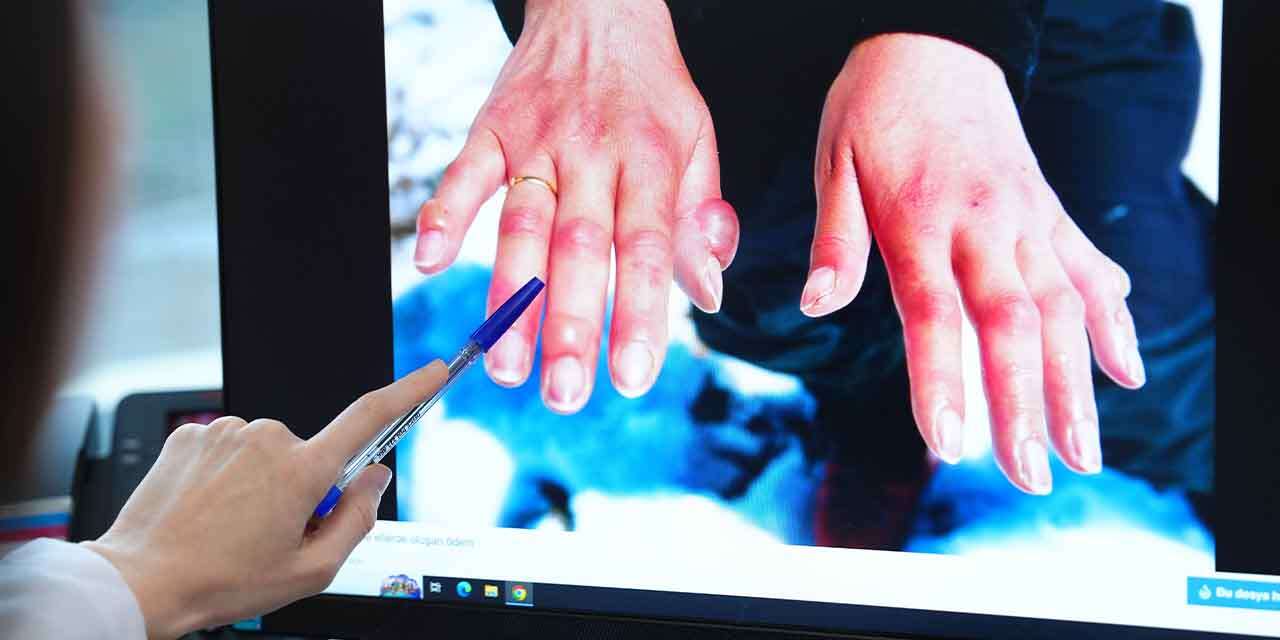 Önlem alınmazsa uzuv kaybına neden oluyor! Soğuk havalarda etkisini gösteriyor