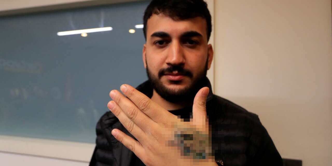 Dövme sildirmek isterken elinden oldu! Nakil gerekiyor