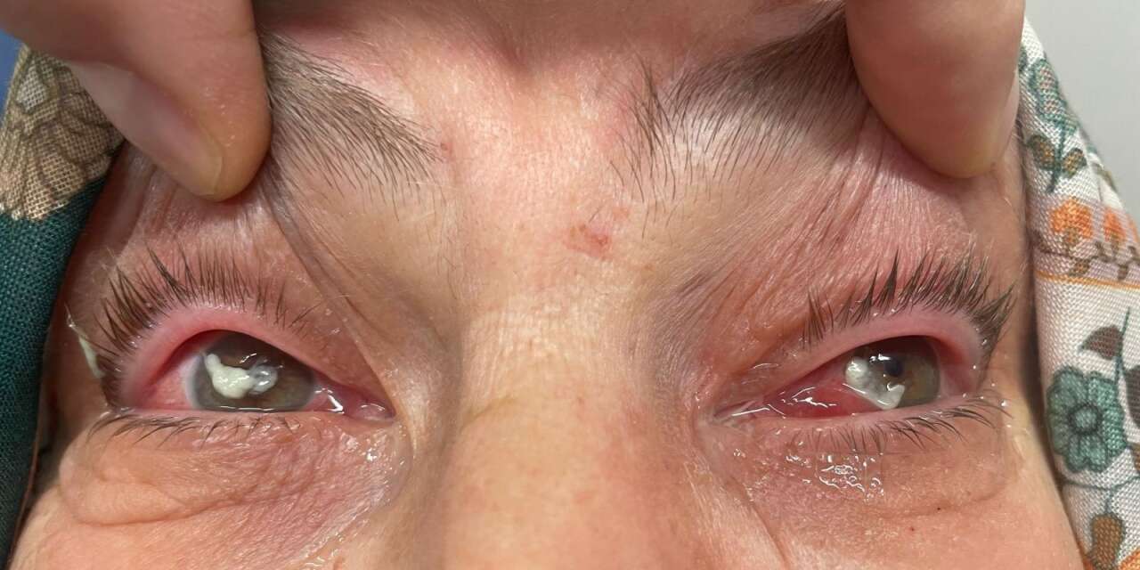 Gözüne damlattığı “kırlangıç otu” az kalsın kör ediyordu