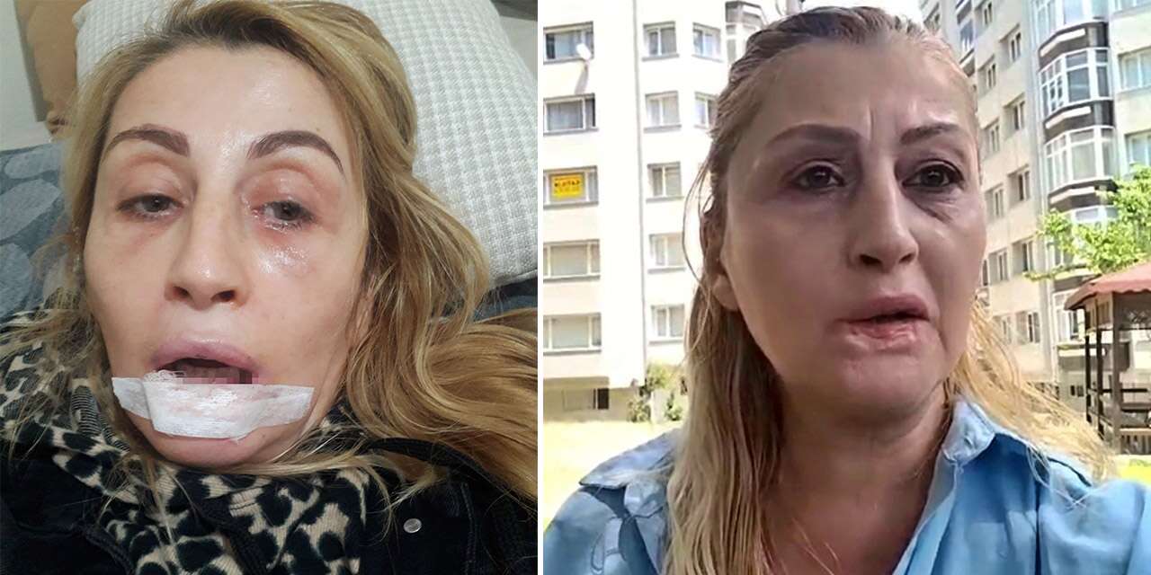 Estetik için gitti, dudağı çürüdü! 7 yıldır adalet bekliyor