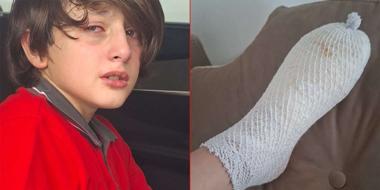 Stres oyuncağı elinde patladı! 11 yaşındaki çocuk yandı