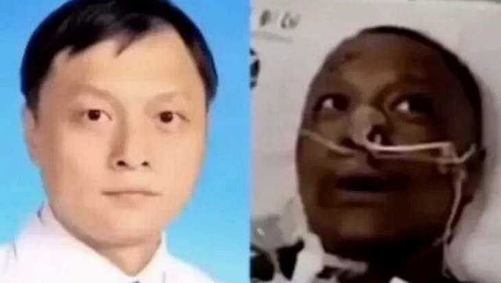 Korona nedeniyle ten rengi değişen Çinli doktor yaşamını yitirdi