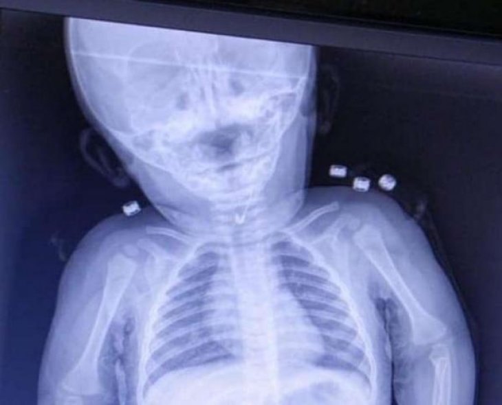 7 aylık bebek çengelli iğne yuttu, operasyonla çıkarıldı