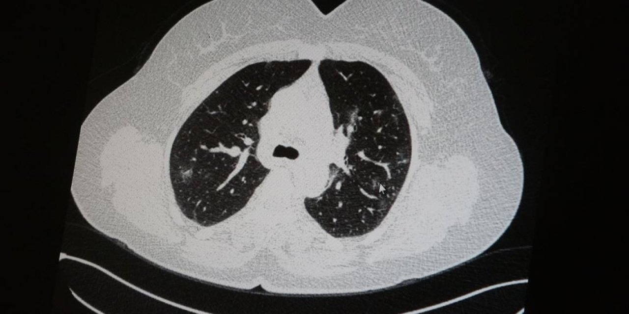 Aşılı ve aşısız halde koronaya yakalanan 2 gencin akciğer tomografisi arasındaki fark görüntülendi