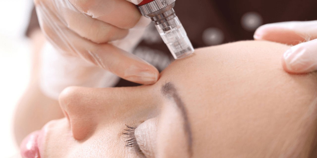 Altın İğne Yöntemi İşe Yarıyor Mu? Medikal Estetik Hekimi Yaprak Konakçı Anlatıyor!