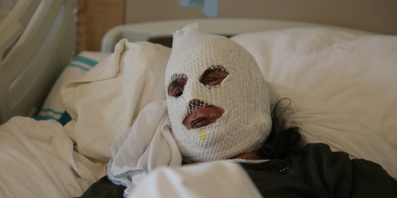 Nusret'in akrabası olan kadın evindeki gaz kaçağını çakmakla kontrol etmek isterken bu hale geldi