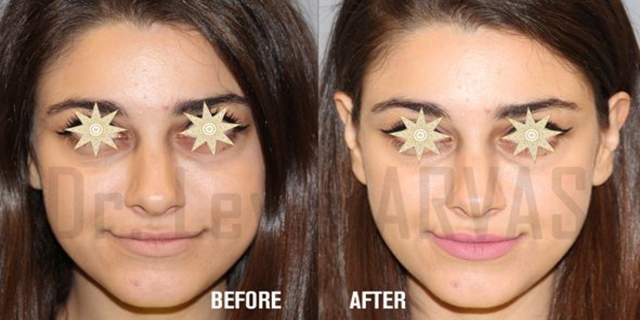 Işık Dolgusu Nedir? Işık Dolgusu Nasıl Uygulanır? Işık Dolgusu Fiyatları Ne Kadar? İşte Tüm Detaylar…