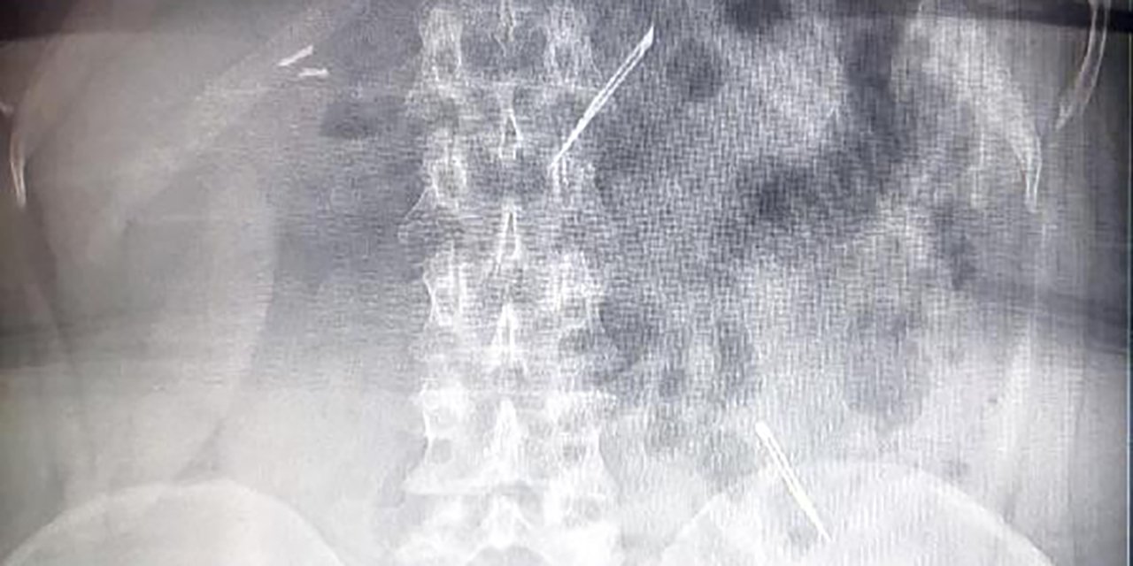 Ağrıları artınca ameliyata alındı, çıkanlar doktorları da şaşırttı