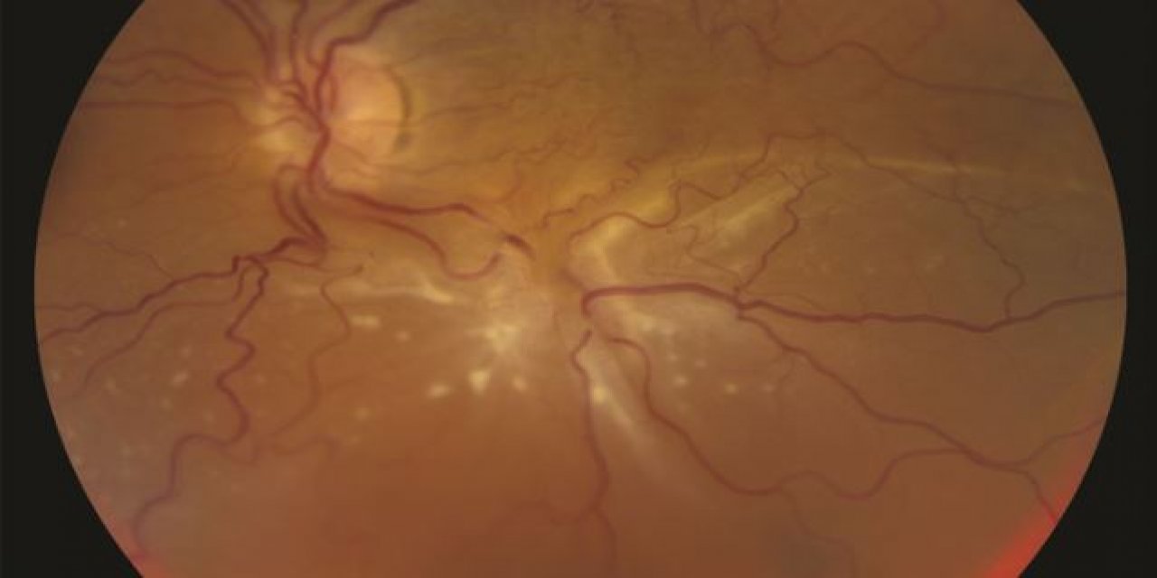 Retina Dekolmanının Nedenleri
