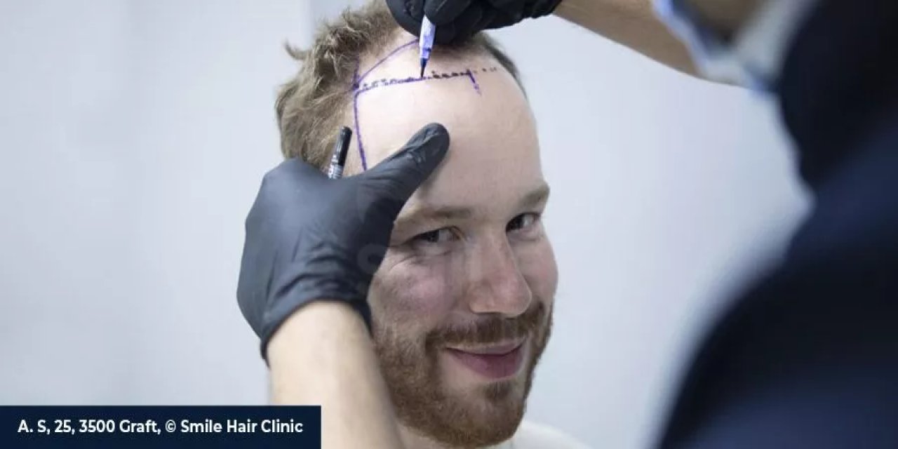 Saç Ekimi ile Kelliğe Kesin Çözüm