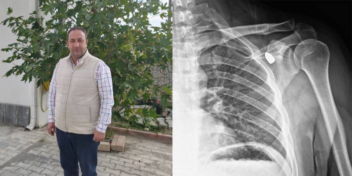 Konya’da 6 yıl omzunda taşıdığı mermi mucizeyle çıktı