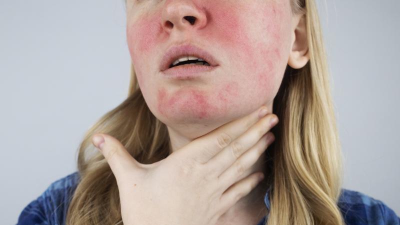 konyada-dermatoloji-uzmanindan-soguk-alerjisi-uyarisi-001.jpg