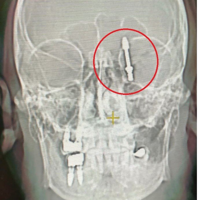 tip-literaturune-girdi-dis-hekimi-implanti-beynine-sapladi-001.jpg