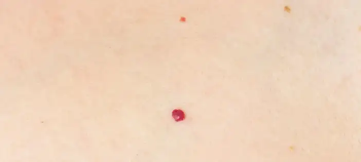 konyada-uzman-isim-uyardi-ciltte-cikan-kirmizi-benleri-hafife-almayin