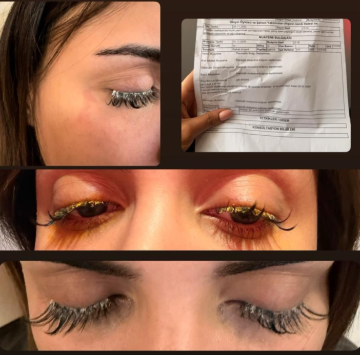 guzellik-icin-gitti-gorme-yetisini-kaybetti