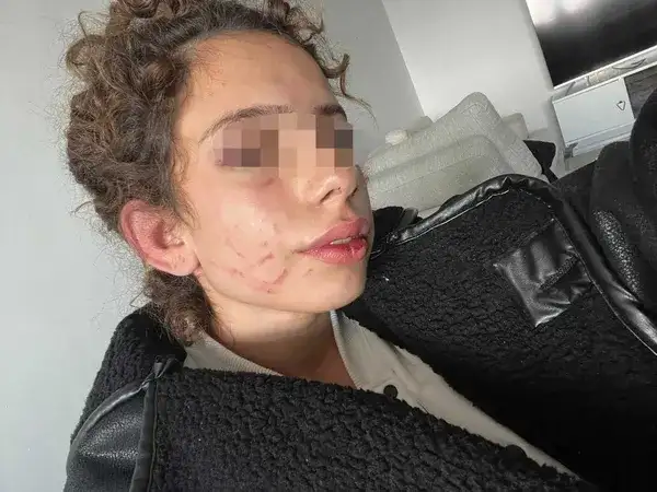 konyada-universitesi-genc-kizi-doven-eski-sevgiliyi-arkadasi-yakti