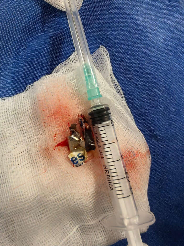 4-yil-once-yuttugu-hap-akcigerinden-cikti