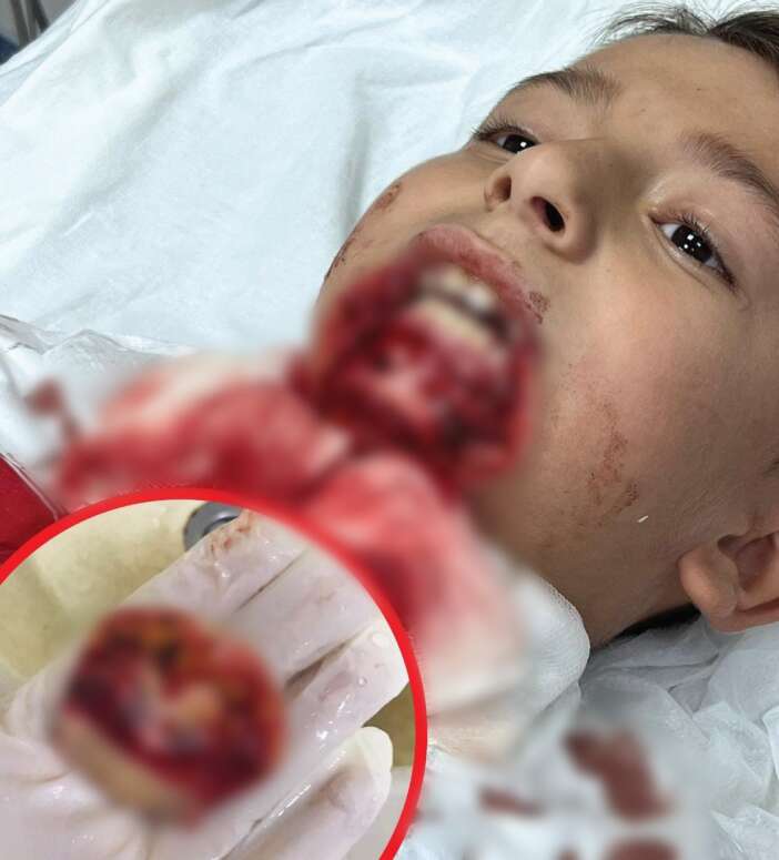 okulda-basina-gelmeyen-kalmadi-cenesine-demir-saplandi-dudagi-koptu