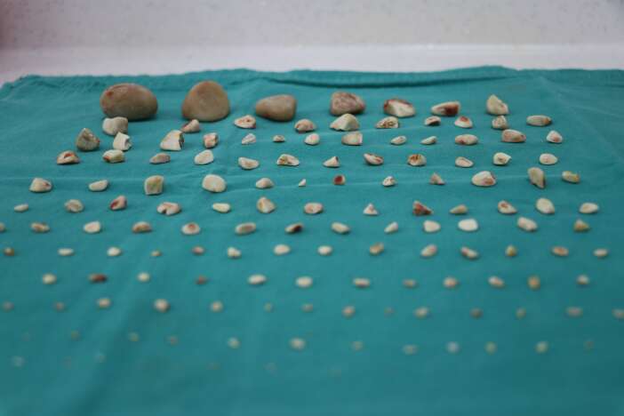 kopegin-idrar-kesesinden-cikanlar-doktoru-bile-sok-etti-yaklasik-140-tane