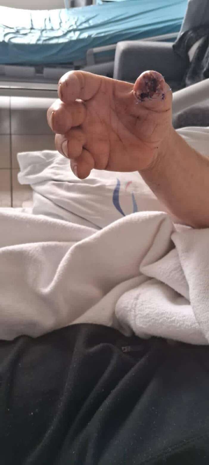 sokak-kopeklerinin-saldirdigi-adamin-parmagi-koptu