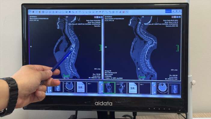 konyada-hastaligi-nedeniyle-yuruyemeyen-genc-21-yil-sonra-ayaga-kalkti
