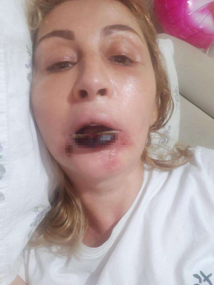 estetik-icin-gitti-dudagi-curudu-7-yildir-adalet-bekliyor